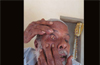 Cataract surgery proves costly; Karkala man loses eye sight